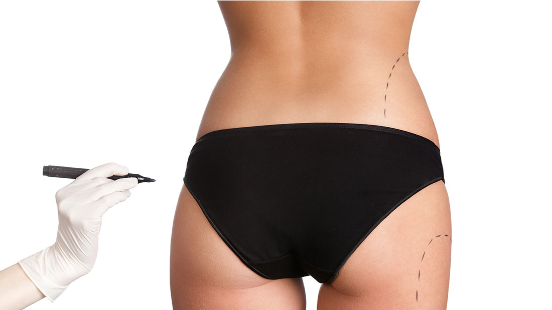 fibrosis post liposucción